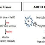 Why Dopamine Detox Fails in ADHD